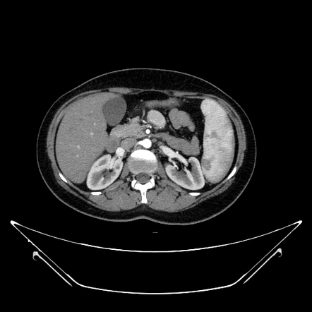 Splenunculus within small bowel mesentery | Radiology Case ...