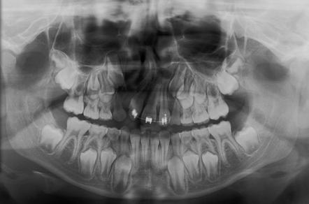 Cleft palate | Radiology Case | Radiopaedia.org