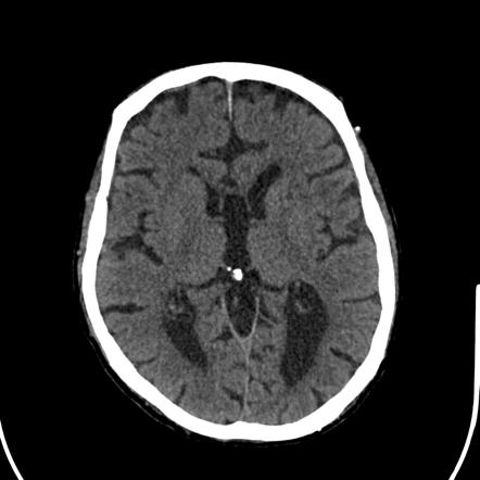 Dysgenesis of the corpus callosum | Radiology Case | Radiopaedia.org