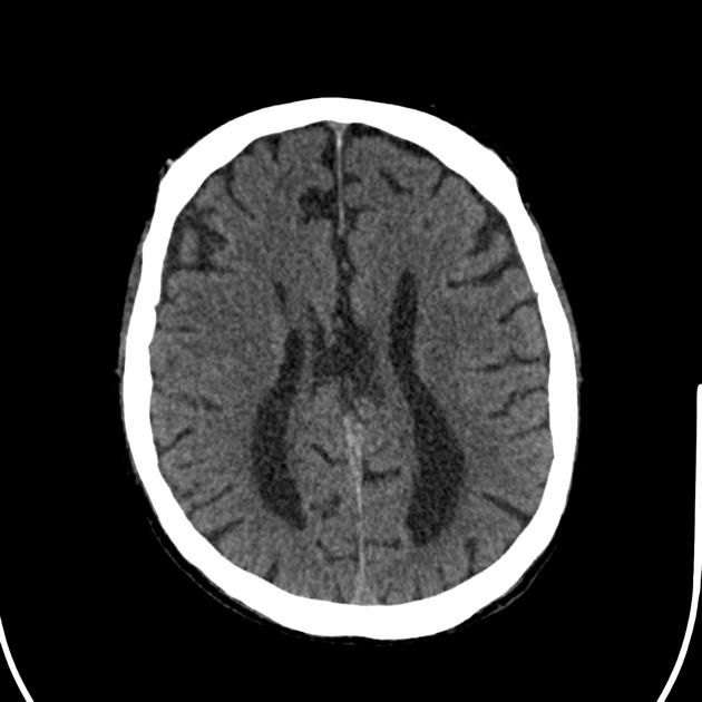 Marchiafava Bignami Disease - slidesharetrick