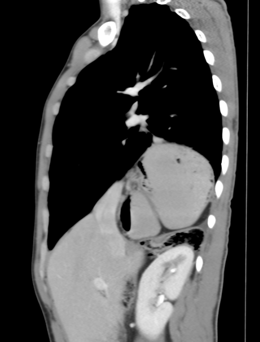 Bochdalek hernia | Image | Radiopaedia.org