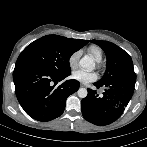 Mucus plugging | Image | Radiopaedia.org