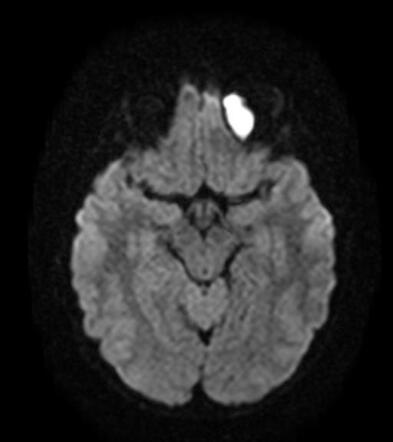 Orbital epidermoid cyst | Radiology Case | Radiopaedia.org