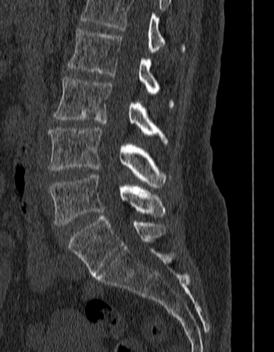 Sacralization Of L5 Image