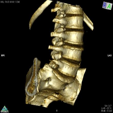 Sacralization of L5 | Image | Radiopaedia.org