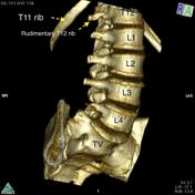 Lumbarization Vs Sacralization