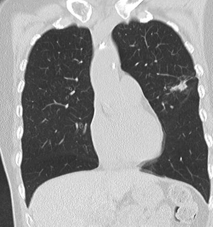 Lepidic Predominant Adenocarcinoma Of The Lung | Image | Radiopaedia.org