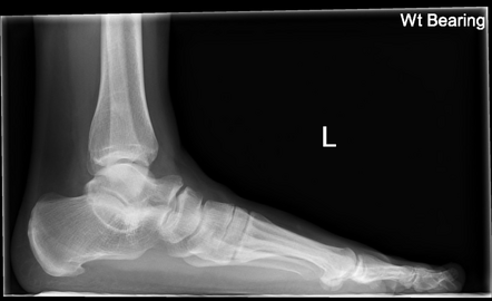 Talocalcaneal coalition | Radiology Case | Radiopaedia.org