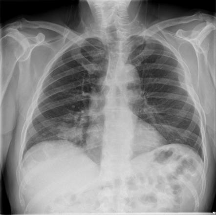 Lung and rib metastasis | Radiology Case | Radiopaedia.org