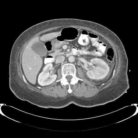 Acute pyelonephritis | Radiology Reference Article | Radiopaedia.org