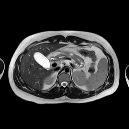 Dorsal pancreatic agenesis | Radiology Case | Radiopaedia.org