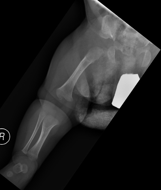 Achondroplasia Image