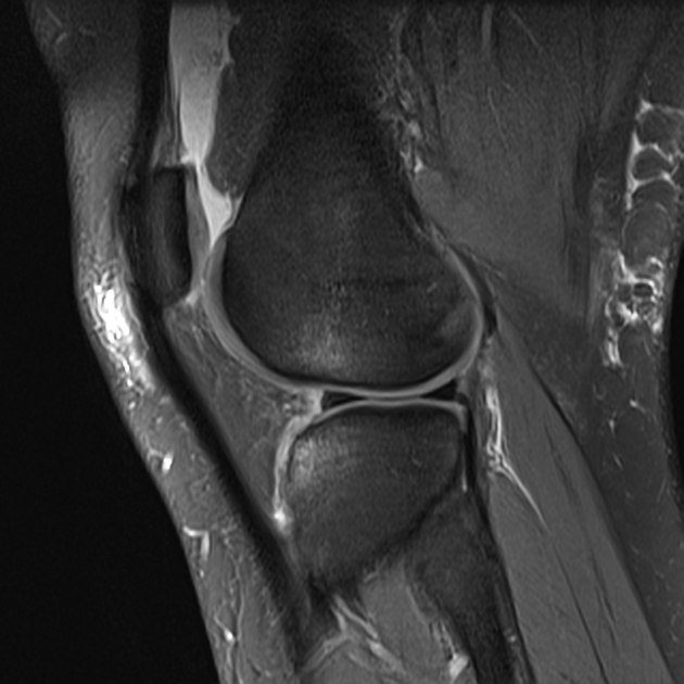 Anterior cruciate ligament tear | Radiology Reference Article |  Radiopaedia.org