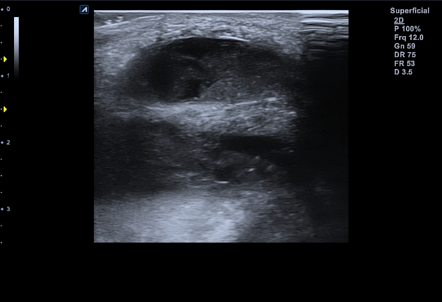 Quadriceps tendon partial tear | Radiology Case | Radiopaedia.org