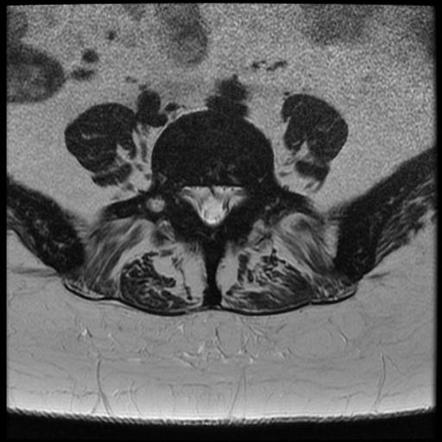 Myelofibrosis | Image | Radiopaedia.org