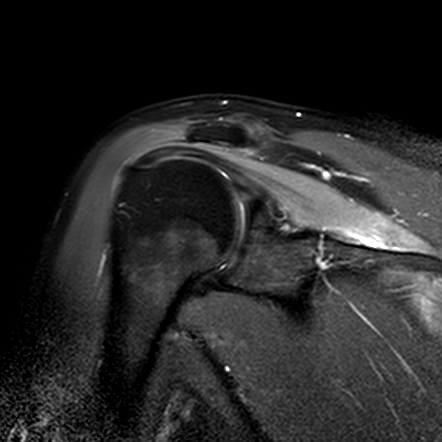 Parsonage-Turner syndrome | Radiology Case | Radiopaedia.org