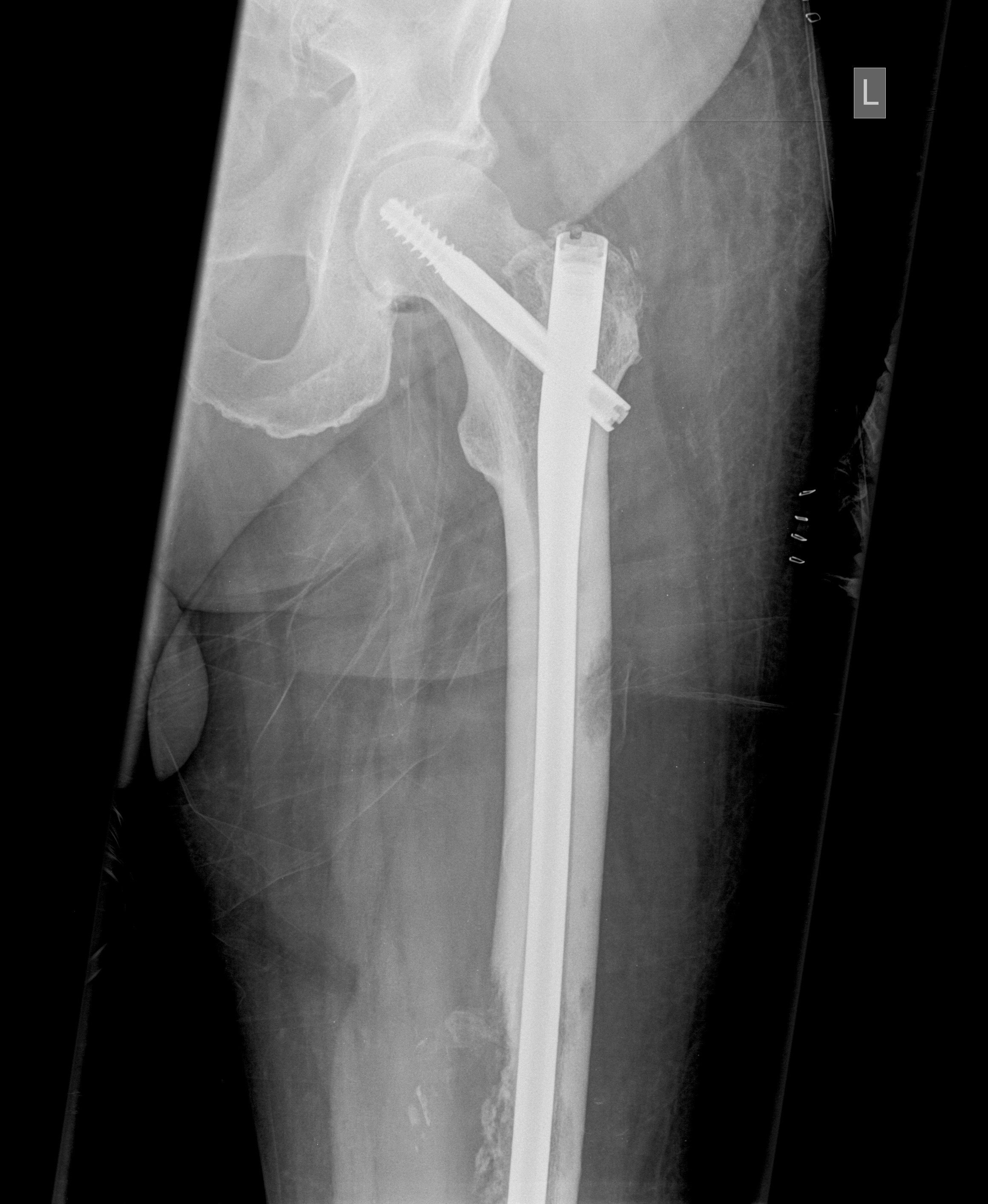 Bone Metastasis Femur Image 8405