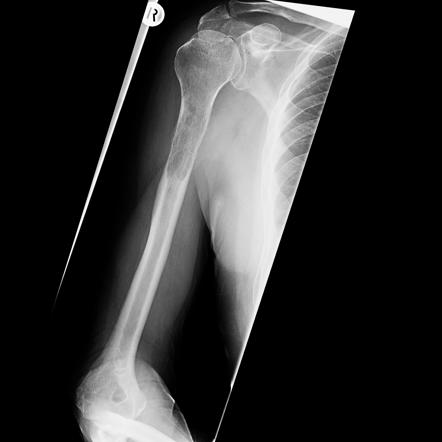 Humerus metastasis from renal cell carcinoma with pathological fracture ...