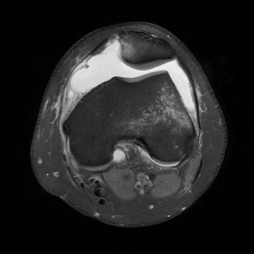 Transient lateral patellar dislocation relocation | Image | Radiopaedia.org