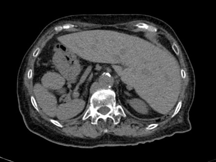 Situs inversus abdominalis and polysplenia | Image | Radiopaedia.org