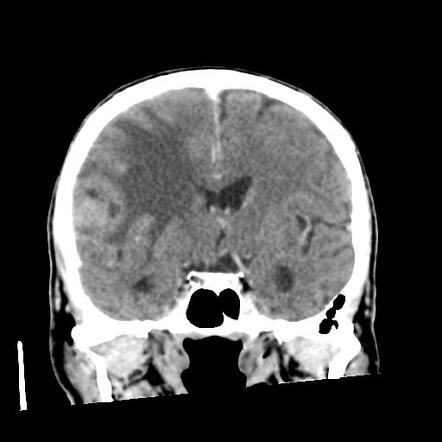 Anaplastic pleomorphic xanthastrocytoma | Image | Radiopaedia.org