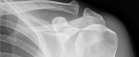 Shoulder annotated x-rays | Radiology Case | Radiopaedia.org