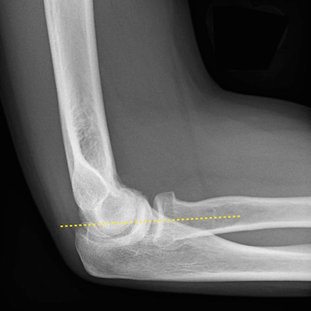 Elbow radiograph (an approach) | Radiology blog post | Radiopaedia.org