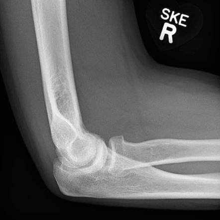 Elbow (annotated X-rays) 