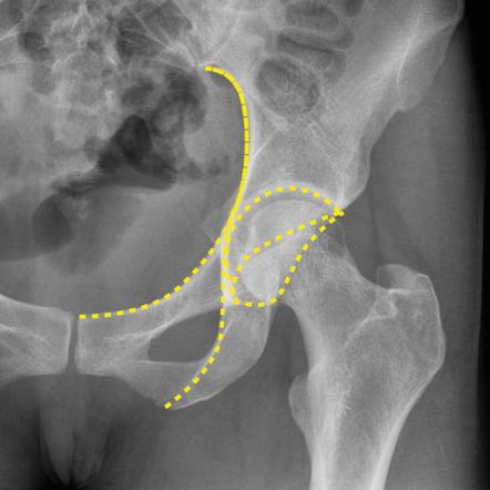 Pelvic radiograph (an approach) | Radiology Reference Article ...