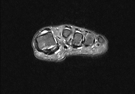 Sesamoiditis | Radiology Case | Radiopaedia.org