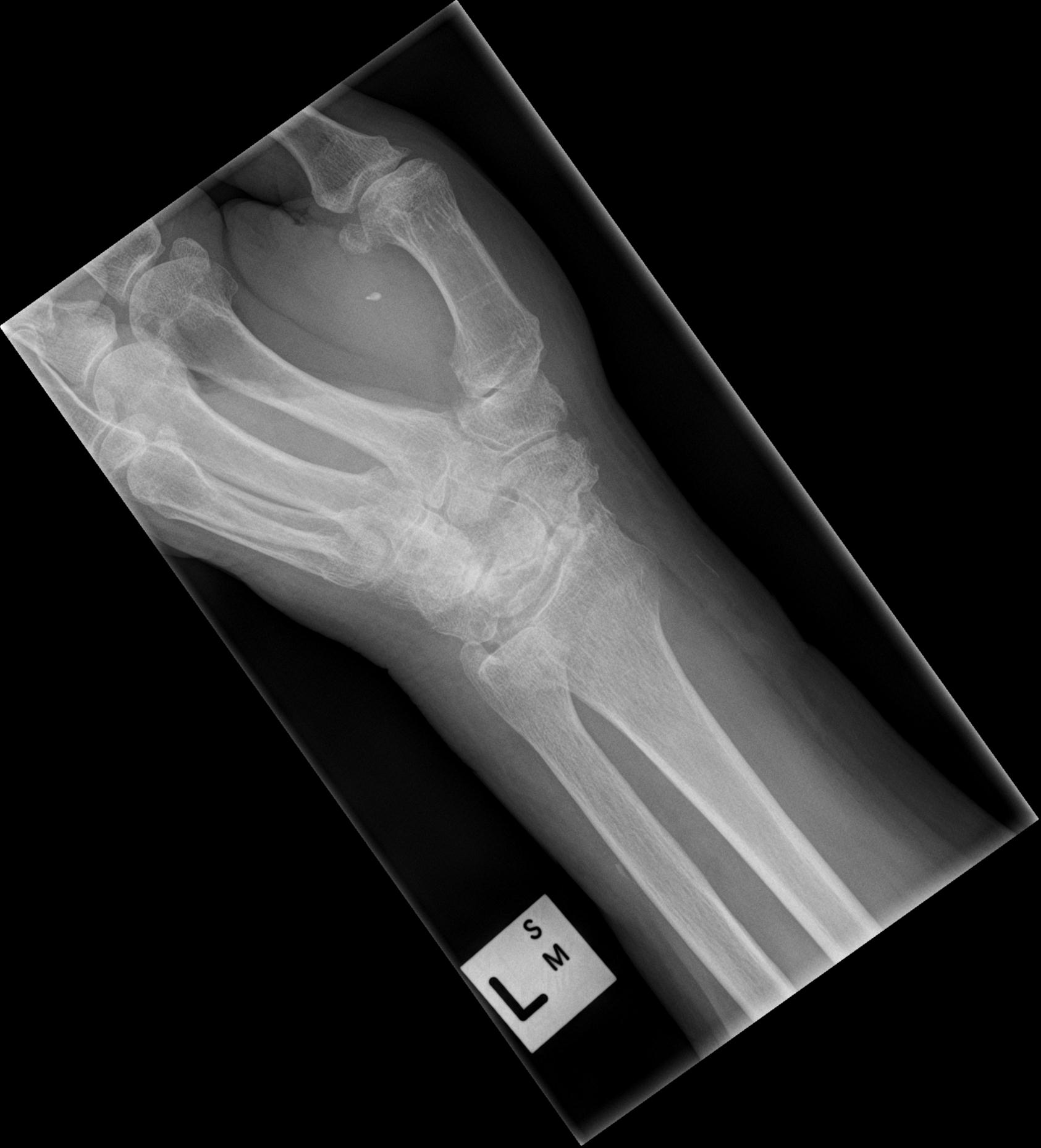 SLAC wrist and distal radius fracture | Image | Radiopaedia.org