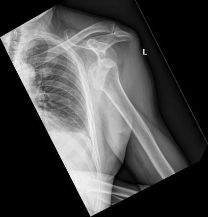 Anterior shoulder dislocation with Hill-Sachs lesion | Radiology Case ...