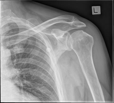 Anterior shoulder dislocation with Hill-Sachs lesion | Radiology Case ...