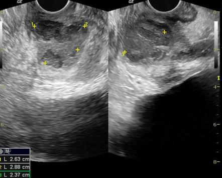 Prostatic abscess | Radiology Case | Radiopaedia.org