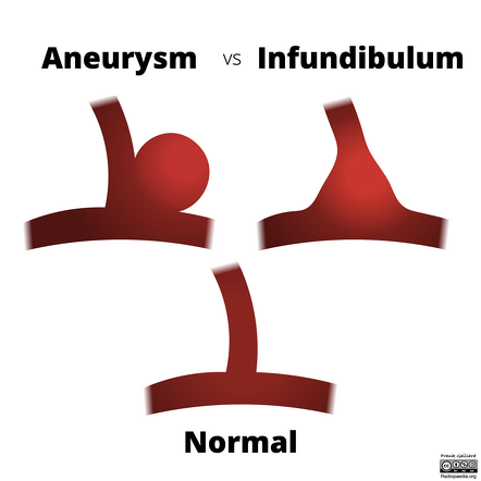 Aneurysm vs infundibulum (illustration) | Radiology Case | Radiopaedia.org