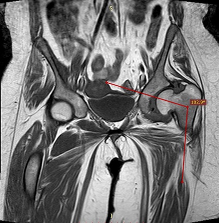 Coxa vara | Radiology Reference Article | Radiopaedia.org