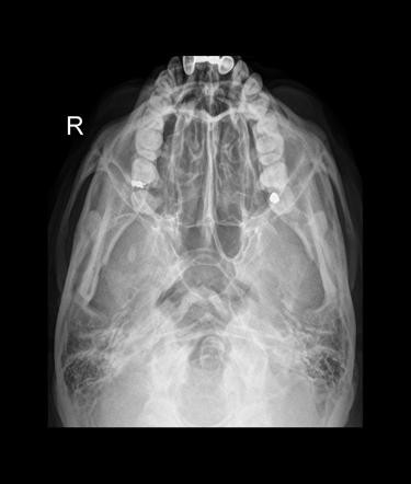 submentovertical zygomatic arches