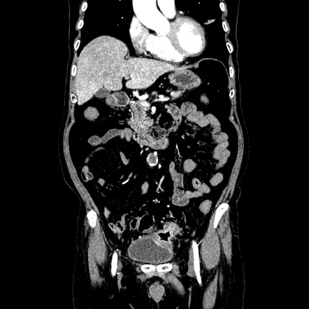 Diverticulitis complicated by a colovesical fistula | Radiology Case ...