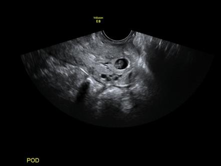 Abnormally low sac position | Radiology Reference Article | Radiopaedia.org