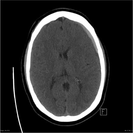 Playlist 'CT Cerebrum ' by Erik Wrange