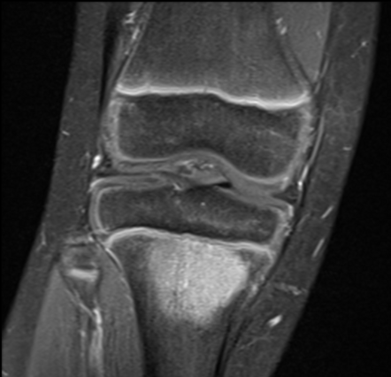 Brodie abscess | Radiology Case | Radiopaedia.org