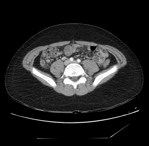 Appendicitis Ultrasound Radiopaedia Details Of The Image Modality