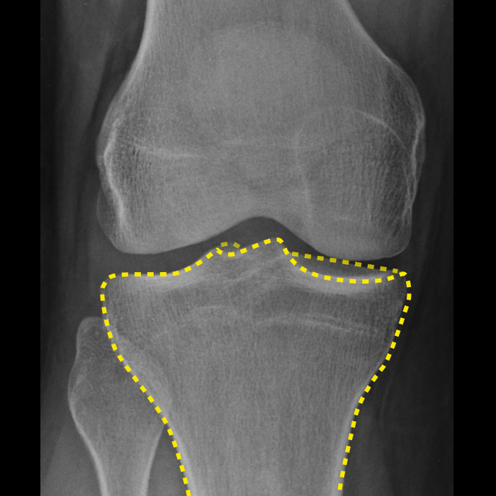 Knee: annotated x-rays | Image | Radiopaedia.org