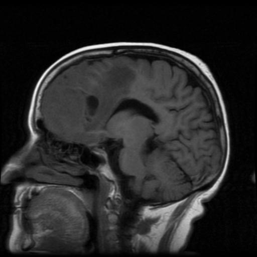 Atypical meningioma (grade II) | Image | Radiopaedia.org