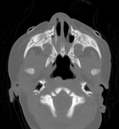 Bilateral choanal atresia | Radiology Case | Radiopaedia.org