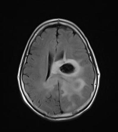 Glioblastoma IDH wild-type (hemorrhagic) | Radiology Case | Radiopaedia.org