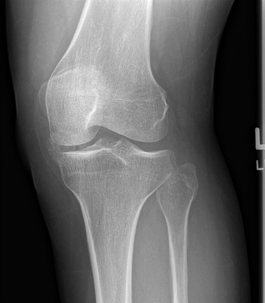 Chronic Hoffa impingement syndrome | Image | Radiopaedia.org