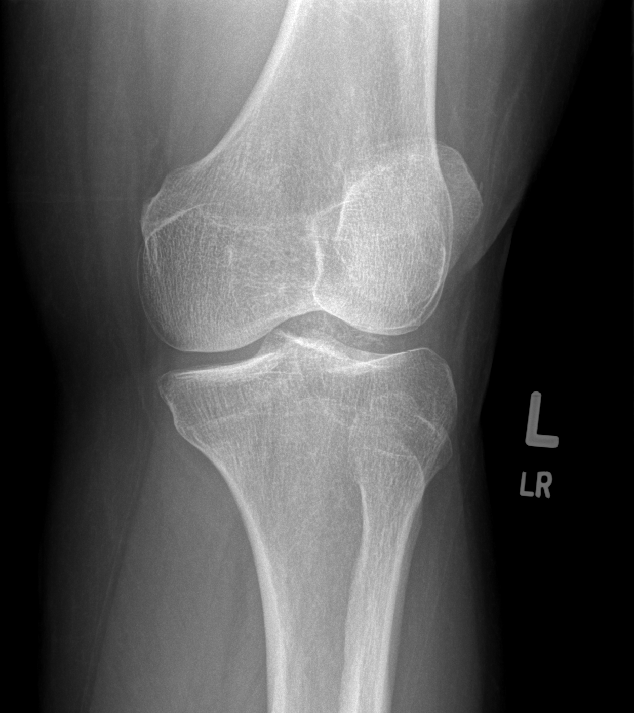 Chronic Hoffa impingement syndrome | Image | Radiopaedia.org