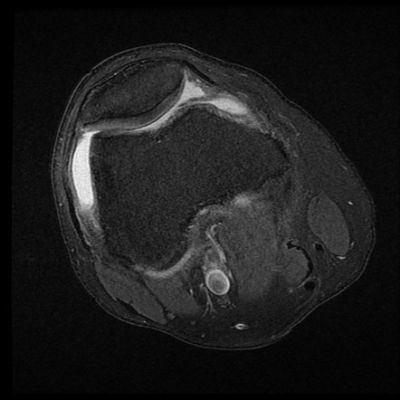 Medial patellar plica syndrome | Radiology Reference Article ...