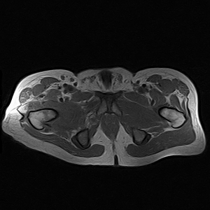 Septic arthritis of the hip | Image | Radiopaedia.org